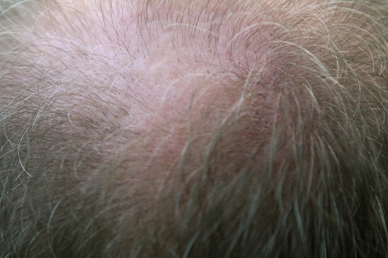 DHT and Its Role in Hair Loss | How RU58841 Works to Inhibit DHT