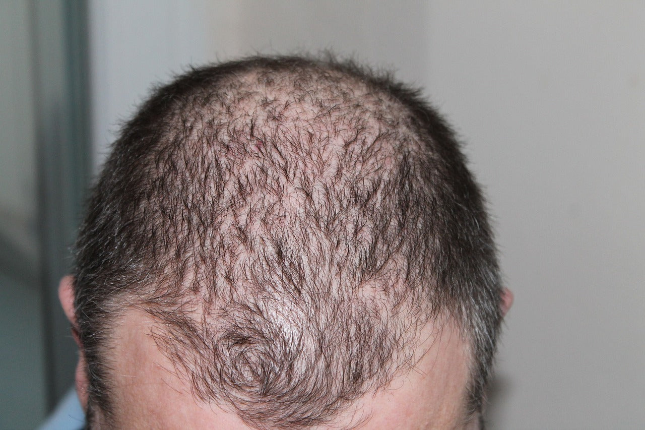 Basics of Androgenetic Alopecia: The Common Causes of Hair Loss